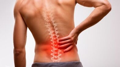 Lomber umurtqasi osteokonrozining belgilari va alomatlari