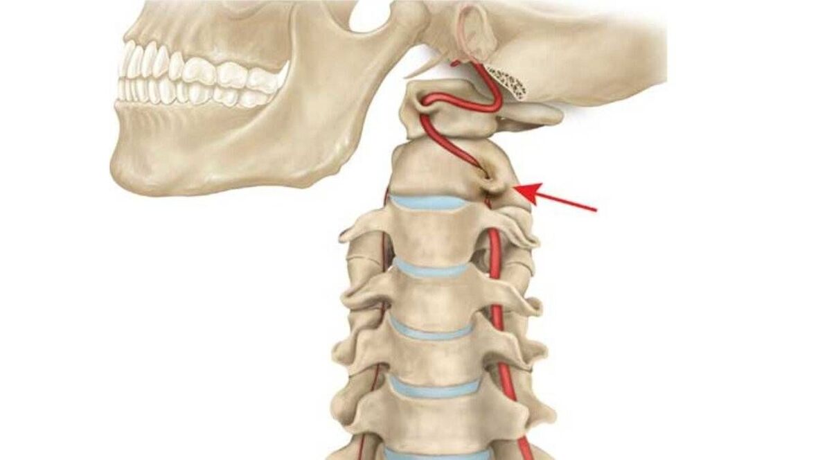 servikal o'murtqa osteoxondroz
